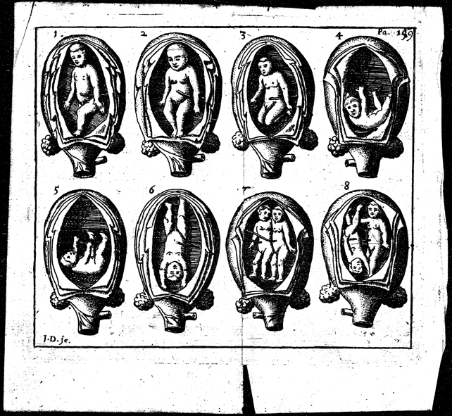 An illustration of twins in the uterus, from Jane Sharp’s The Midwives Book (1671).